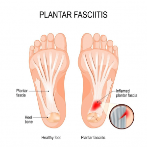 Plantar Fasciitis: What Is It? What To Do About It?, Auto-Ness Physical Therapy- Physical Therapy Scripps Ranch